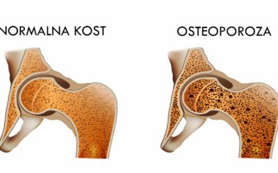 Osteopenija predstopnja osteoporoze?